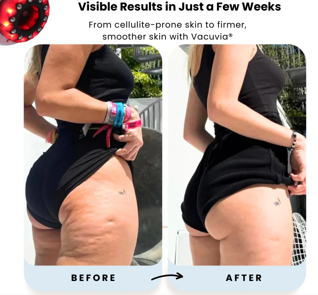 Vacuvia SculptGlow - firmer, more toned SKIN